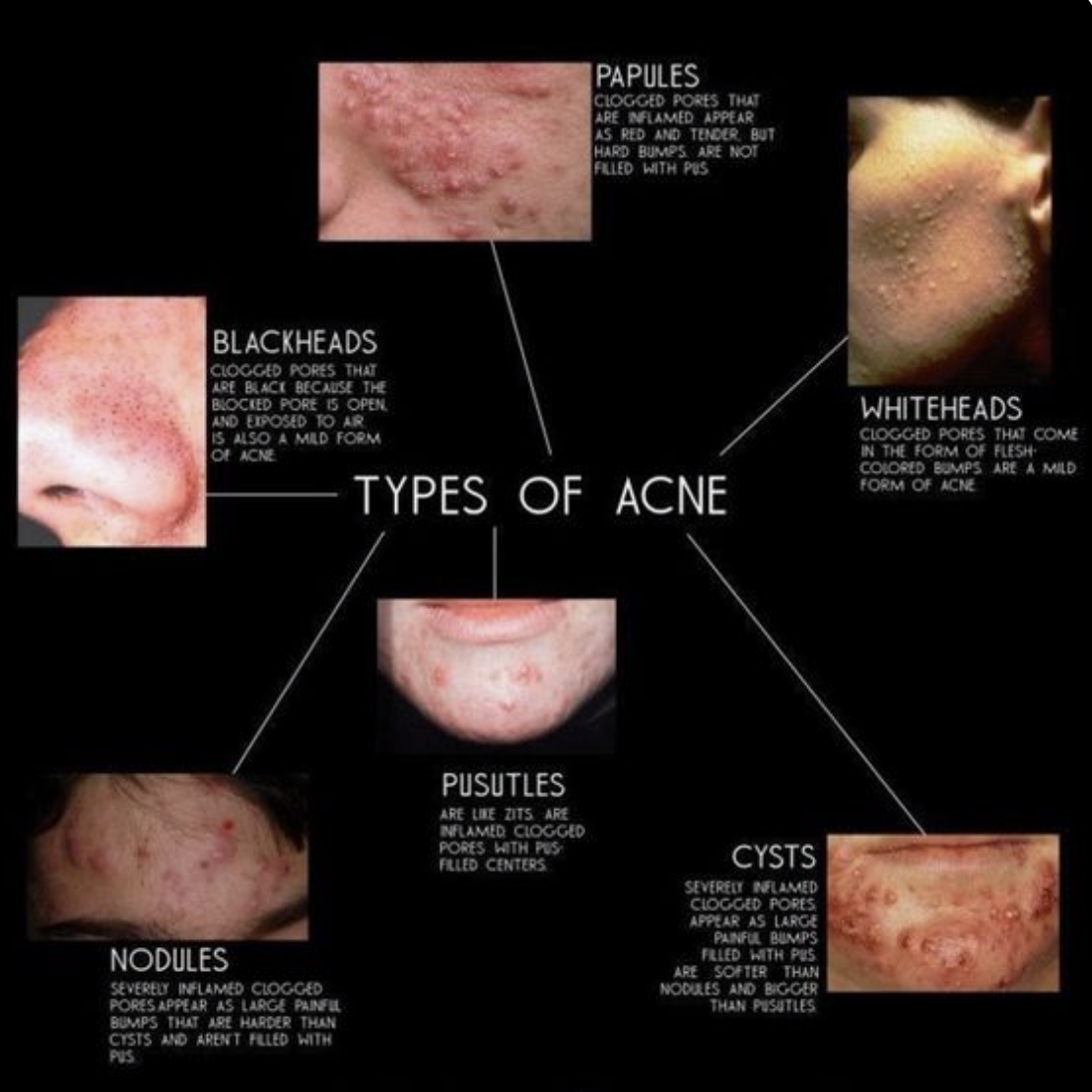 acne nodule vs cyst